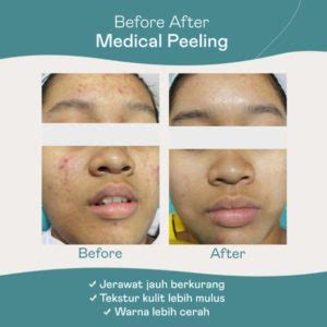 Cara Kerja Dan Manfaat Treatment Chemical Peeling Estetiderma