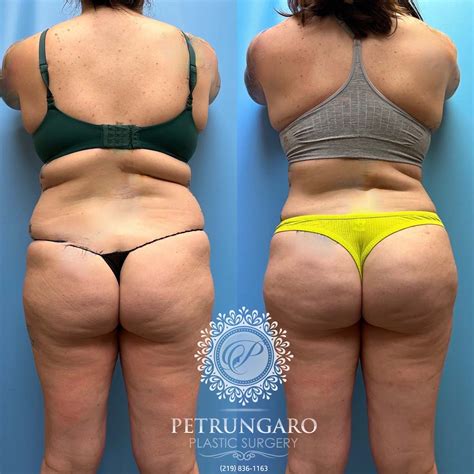 Tummy Tuck Lipo 360 Brazilian Butt Lift Renuvion Petrungaro