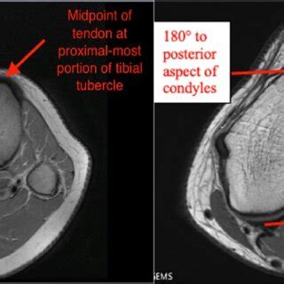 Tibial Tubercle Trochlear Groove Distance Measurement On Axial Mri