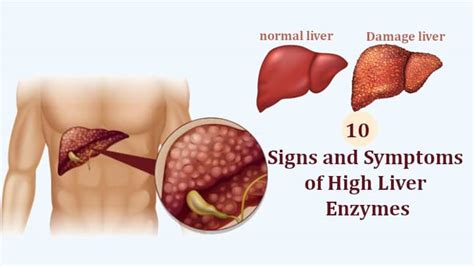 Signs and Symptoms of High Liver Enzymes Causes and Treatment