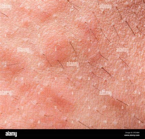 Eczema Dermatite Atopica Sintomo Della Texture Della Pelle Foto Stock