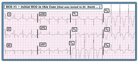 Dr Smith S Ecg Blog Diffuse T Wave Inversions And A Very Long Qt