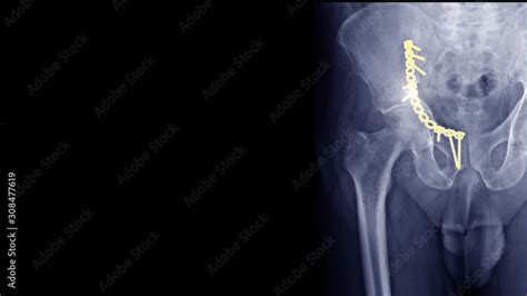 Film X-ray hip radiograph show broken hip bone or acetabular fracture ...