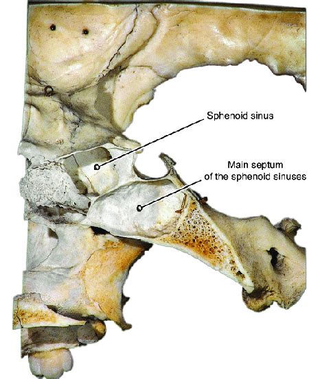 Sphenoid Bone Extracted Sphenoid Sinuses View From Lateral