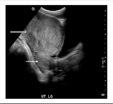 Figure 1 from Ovarian Dysgerminoma | Semantic Scholar