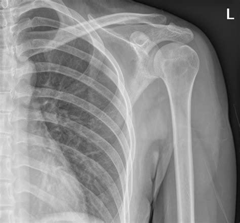 Xray Shoulder Normal