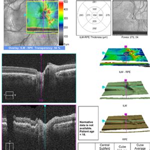 PseudoFosterKennedy Syndrome Retina Image Bank