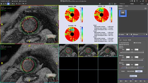 Mr Cardiac Advanced Visualization Package Terarecon