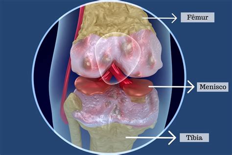 Lesão no menisco por que ocorre e como tratar Dr Lucas Cordeiro