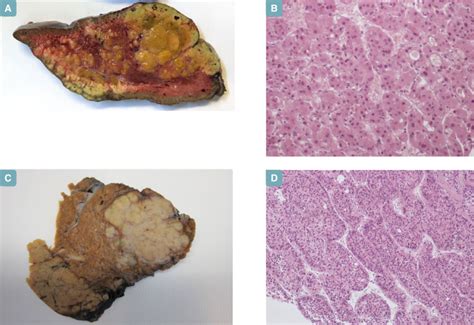 Pathology Of HCC This Figure Illustrates Some Of The Most Typical