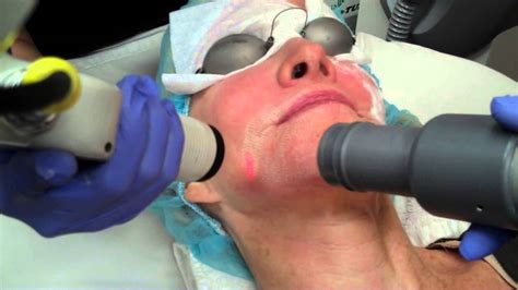 Co2 Active Fx Fractional Laser At Body Beautiful Spa 602 522 9222 Youtube