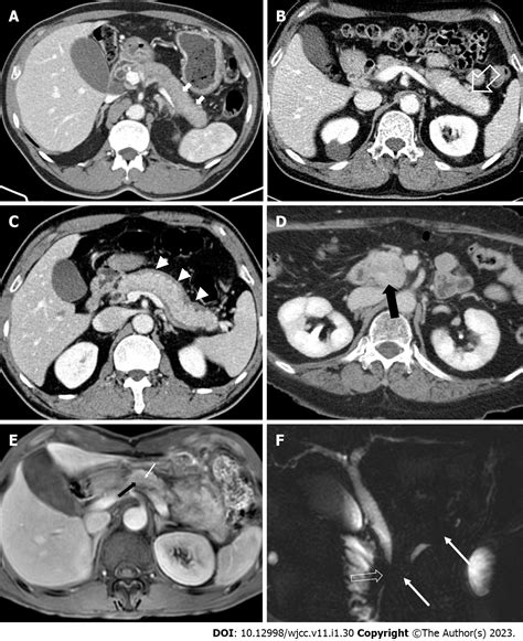 Challenges For Clinicians Treating Autoimmune Pancreatitis Current Perspectives