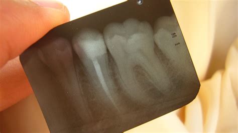 What are the Complications of a Root Canal? | Drjcares Root Canal