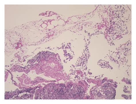 Pathological Examination Of Biopsy Specimens Revealing Squamous Cell