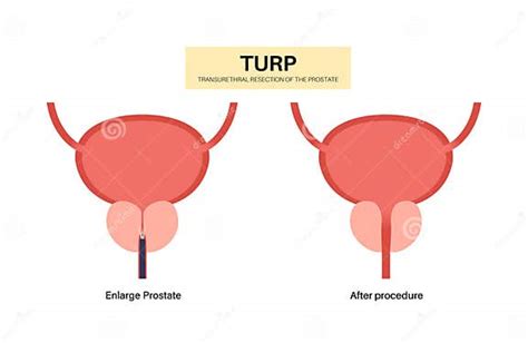 Transurethral Resection Of The Prostate Stock Illustration