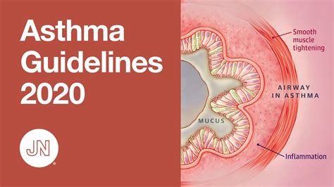 Asthma Guidelines Update 2020 Diagnosis And Management Youtube