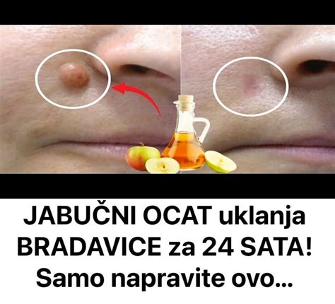 Jabu Ni Ocat Uklanja Bradavice Za Sata Samo Napravite Ovo