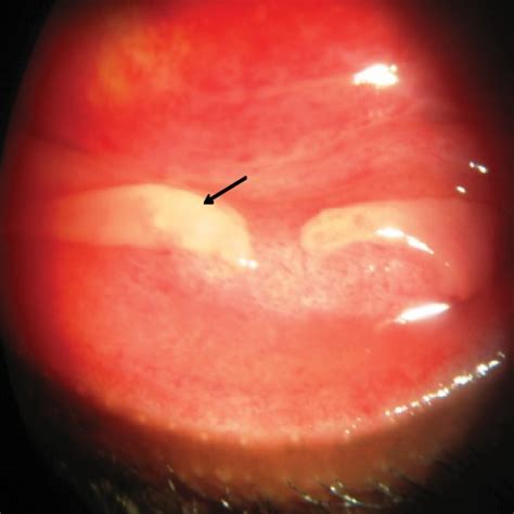 Slit Lamp Photography Of Superior Palpebral Conjunctiva With Petechial