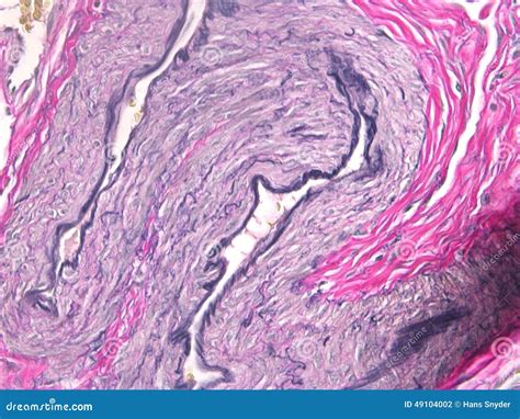 Epididymal Cyst Histology