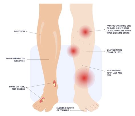 Peripheral Artery Disease | The Foundation to Advance Vascular Cures