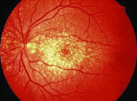 18 Fundus Findings In Doynes Honeycomb Macular Dystrophy Malattia