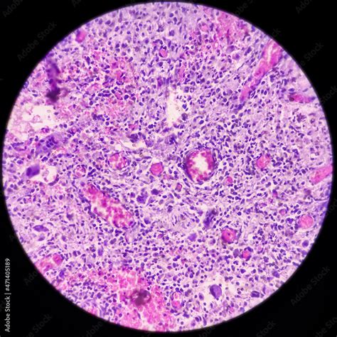 Perianal Region With Fistula Tract Chronic Granulomatous Inflammation