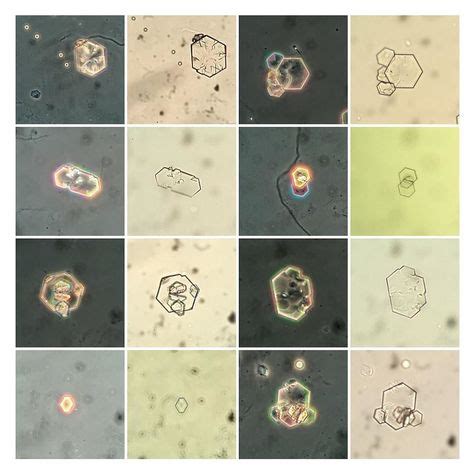 Id Es De Cristaux Urinaires Cristaux Analyse Medicale