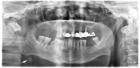 Sialoliths Of Submandibular Gland And Whartons Duct Orthopantomography