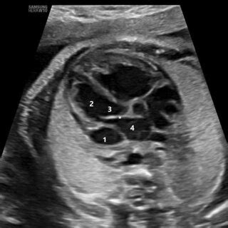 Fetal Echocardiogram Bicaval View Showing Ivc Color Doppler And Lsvc