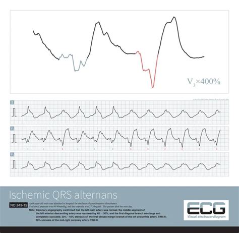 Un Paciente Con Infarto Agudo Extenso De Miocardio Anterior E Inferior