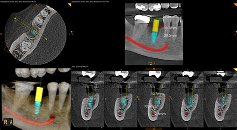 CBCT Scans For Dental Implants Oral Radiology Toronto