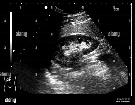 Normal Kidney Ultrasound