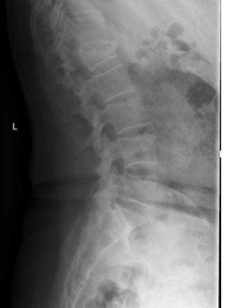 Lumbar Spine X Ray Diagram Quizlet