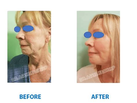 Facelift Surgery In Delhi Face Lift India Cost In New Delhi South