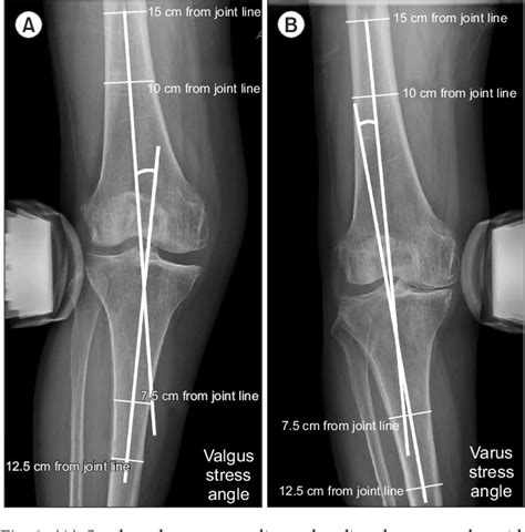 Knee Valgus Vs Varus