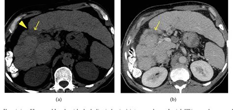 Figure 1 From Mdct Imaging Findings Of Liver Cirrhosis Spectrum Of