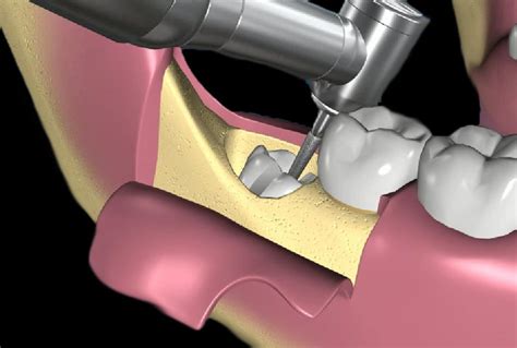 Estrazioni Denti Del Giudizio Dentista Mb Lugano