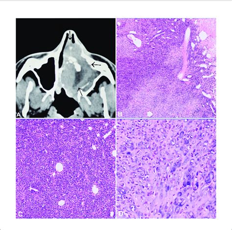 Mesenchymal Chondrosarcoma A Ct Scan Showing An Aggressive Tumour