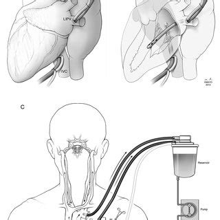 A Position Of Various Cannulae Including Venous Cannula In The Right