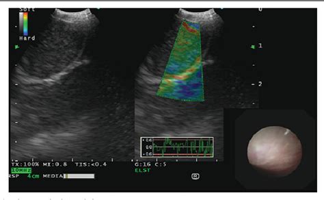 Figure From Qualitative Role Of Endobronchial Elastography With