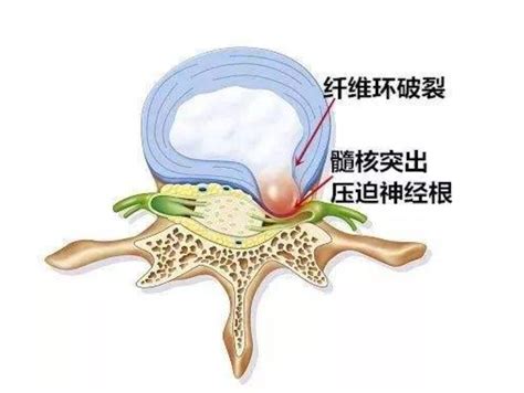 腰椎间盘突出，纤维环破裂还能否修复？腰椎间盘突出 好大夫在线