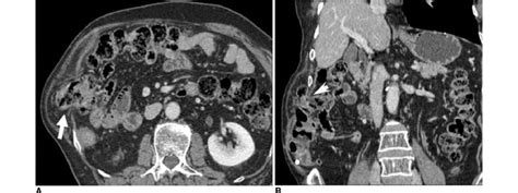 74 Year Old Man With Palpable Mass On Right Flank A Axial Mdct Scan Download Scientific