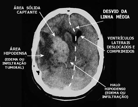 Entenda Como Identificar Os Principais Tumores Cerebrais