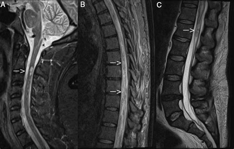 Guillain Barr And Transverse Myelitis Overlap Syndrome Two Case