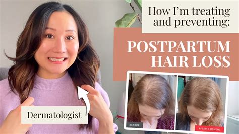 Dermatologist Tips For Postpartum Hair Loss Prevention And Treatments