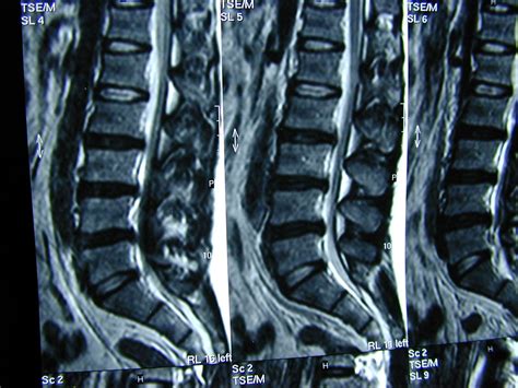 Total Imagem Cirurgia De Bico De Papagaio Na Cervical Br