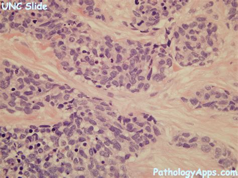 Desmoplastic Small Round Cell Tumor Pathology