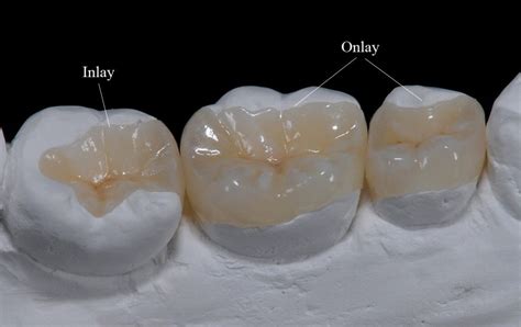 Composite Inlays Onlays Premier Dental Center Ferndale WA