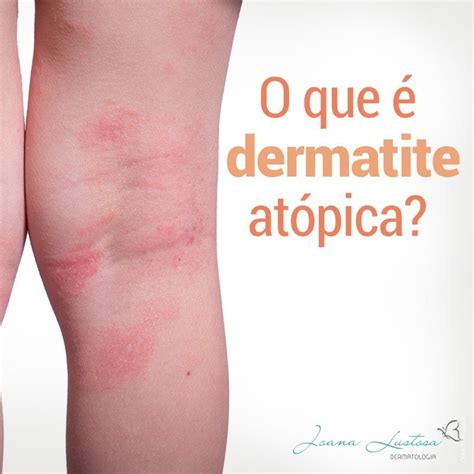 O que é dermatite atópica Dra Joana Lustosa