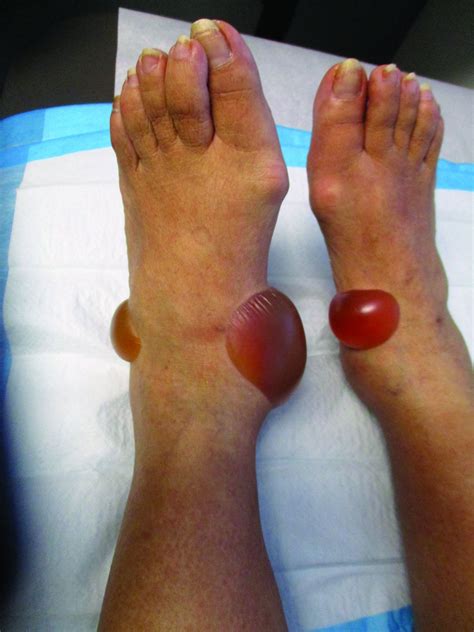 A 67 Year Old White Woman Presented With 2 Weeks Of Bullae On Her Lower